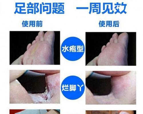 揭秘癣药价格之谜（探究癣药市场中的价值链与供需矛盾）