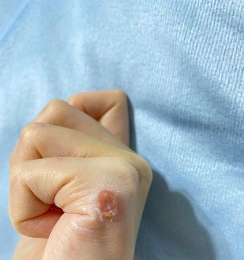 以身上长猫藓的原因及治疗方法（了解身上长猫藓的时间、症状和预防措施）